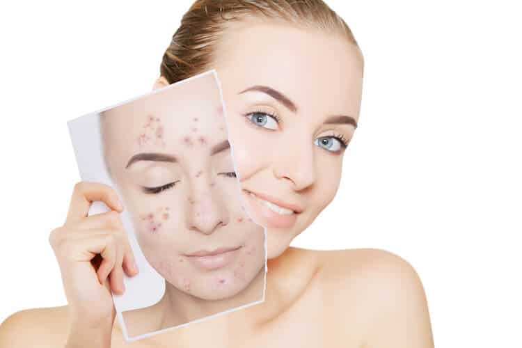 Face Masks Causing Acne? Learn How Facials Can Help Your Skin